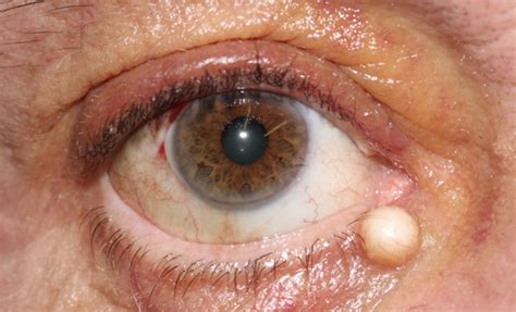 sebaceous cyst eyelid